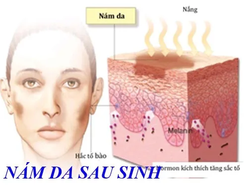 Nám da sau sinh ư??? Hãy dùng tinh bột nghệ