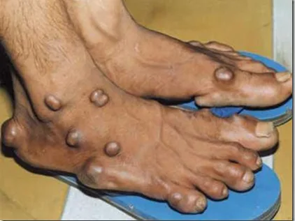 Món ăn người mắc bệnh gout không nên ăn