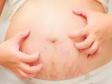 Tinh bột nghệ cho chị em sau khi sinh.