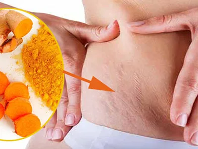 Trị rạn da sau khi sinh với tinh bột nghệ
