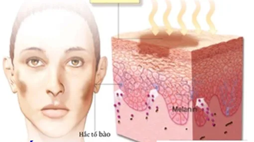 Nám da sau sinh ư??? Hãy dùng tinh bột nghệ
