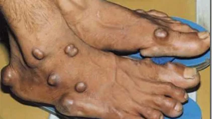 Món ăn người mắc bệnh gout không nên ăn