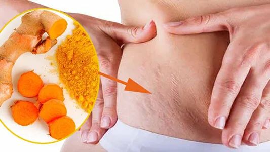 Trị rạn da sau khi sinh với tinh bột nghệ