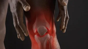 TINH CHẤT NGHỆ CURCUMIN - HOẠT CHẤT CHỐNG VIÊM KHỚP DẠNG THẤP